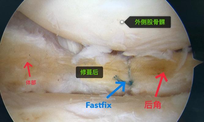 如何自测半月板损伤（简易方法帮助你了解自身膝盖问题）